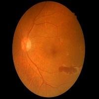 Diabetic Retinopathy: What Is It? 
